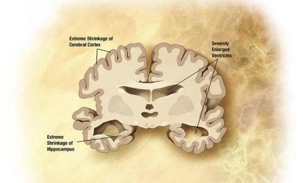 Alzheimer's_disease_brain_severe
