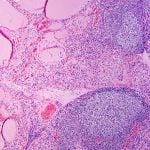 Hashimoto's thyroiditis with lymphoid infiltration