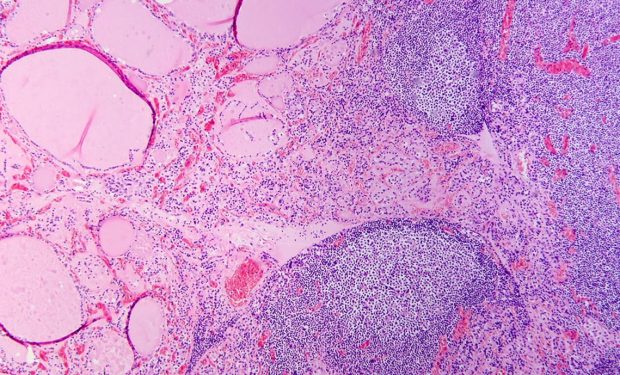 Hashimoto's thyroiditis with lymphoid infiltration